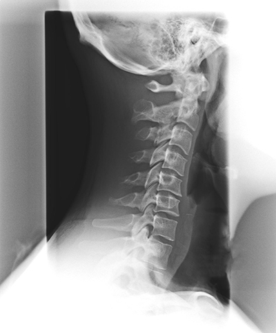 Spinal degeneration phase 2