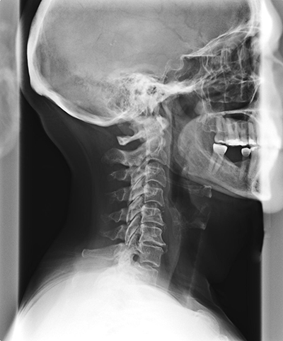 Spinal degeneration phase 3