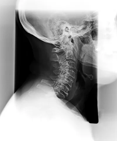 Treatment For Phase 4 Spinal Degeneration Near Me in Spring Hill, TN. Chiropractor For Spine Degeneration Pain Relief.